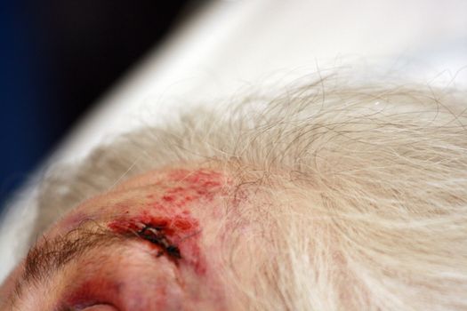  stitches and a bruise on the eyebrow of an elderly woman