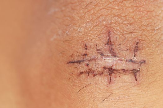 Recovering scar from stitches operation with shallow depth of field