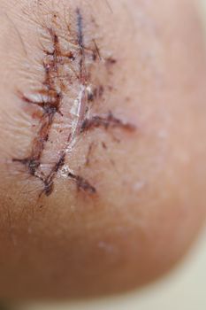 Close up of scar with stitches with shallow depth of field
