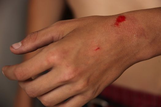 Bleeding Scraped Wrist of a Teenage Boy