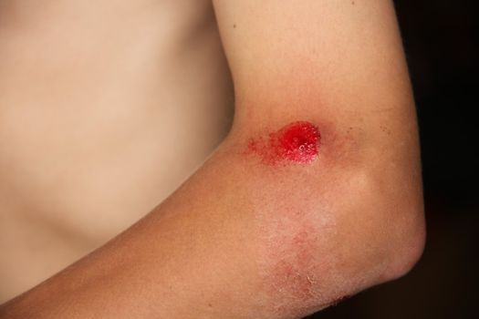 Scraped Up Bleeding Elbow of a Young Boy