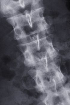 x-ray