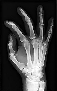 a healthy hand of an X-ray photo