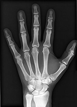 a healthy hand of an X-ray photo