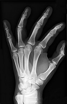a healthy hand of an X-ray photo