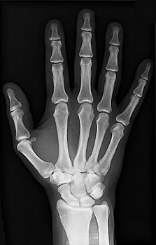 a healthy hand of an X-ray photo