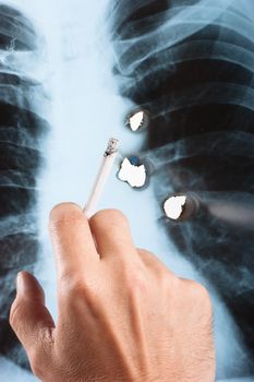 X-ray lung with a hand holding a cigarette