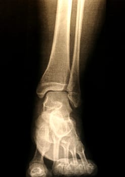 A X-ray of a foot