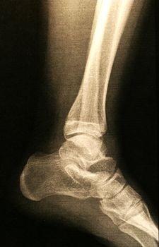 A X-ray of a foot