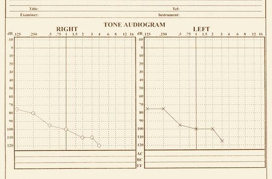 details of hearing medical chart showing, audiology