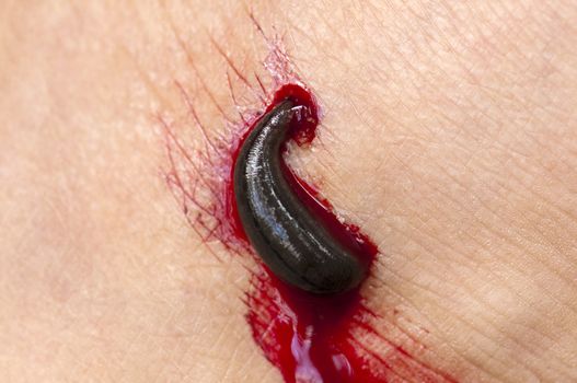 Leech sucking blood from a leg.