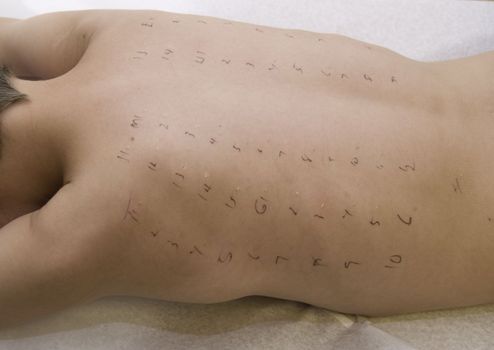 Boy's body marked for allergy testing.