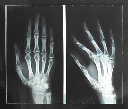 Medical X-Ray imaging of hand fingers used in diagnostic radiology of skeleton bones