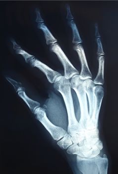 Medical X-Ray imaging of hand fingers used in diagnostic radiology of skeleton bones