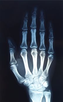 Medical X-Ray imaging of hand fingers used in diagnostic radiology of skeleton bones