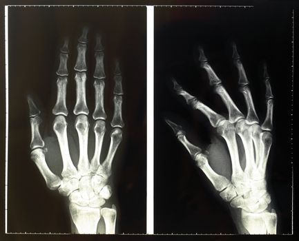 Medical X-Ray imaging of hand fingers used in diagnostic radiology of skeleton bones