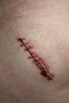 View of the stitches on a cicatrice of a female belly after an appendicitis operation.