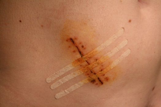 View of the stitches on a cicatrice of a female belly after an appendicitis operation.