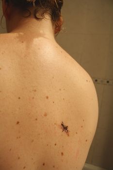 The back of a woman after removing a nevus by surgery.