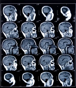 health medical image of an mri of the head showing the brain