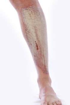 Psoriasis on leg with blood 