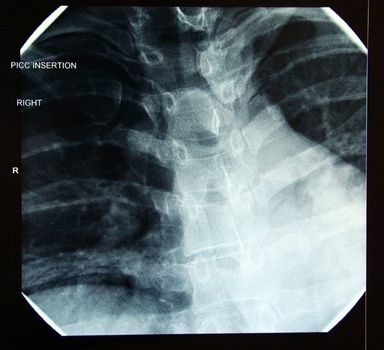 X-ray of correct final PICC (peripherally inserted central catheter) line placement in heart (Female32)