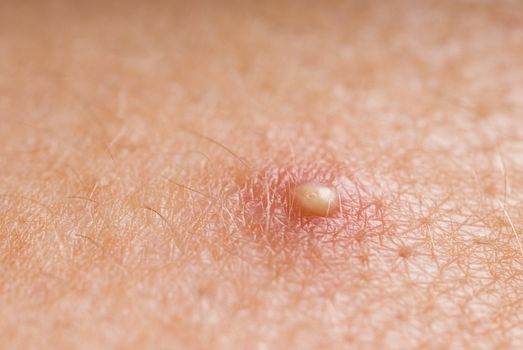 macro image of an ugly white head zit, pictured with a narrow depth of field