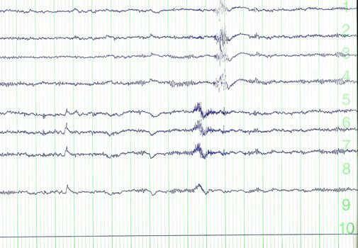 pulse trace of oscilloscope for a electro-encephalogramme (EEG) for search epilepsie 