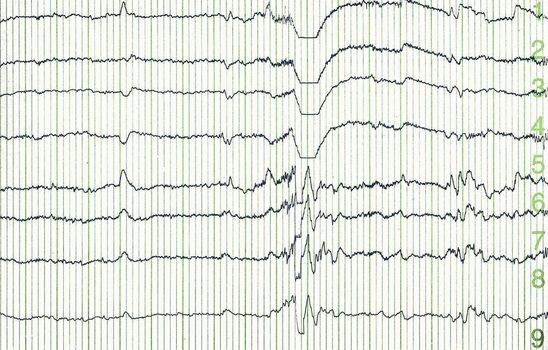 pulse trace of oscilloscope for a electro-encephalogramme (EEG) for search epilepsie 