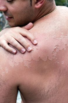 Close up detail of a very bad sunburn showing the peeling blistered skin of a mans back.  Shallow depth of field.