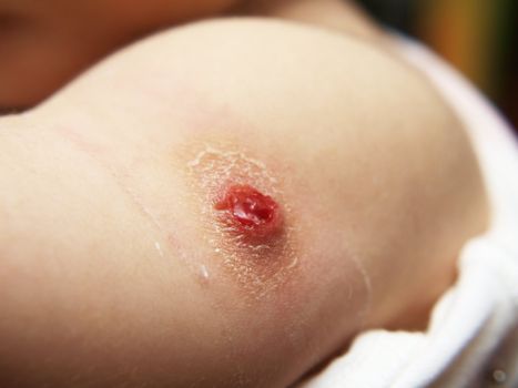 Wound on little person, BCG vaccination reaction