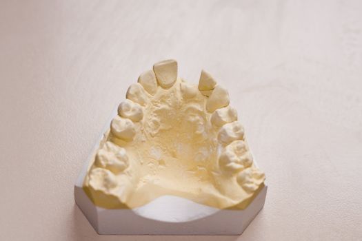 Dental study cast of upper teeth with damaged incisor