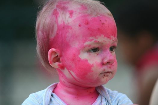 Baby portrait - Chickenpox