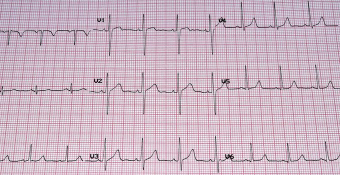 Heart analysis, ECG graph.