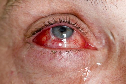 Eye injury - red eye with tears - close-up