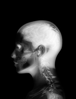 X Ray image of the inside of a womens head.