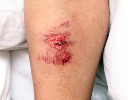 wound