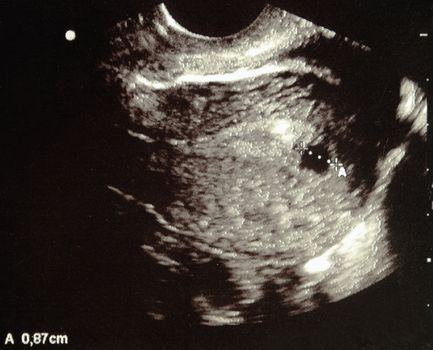 Ultrasound scans during pregnancy in the sixth week