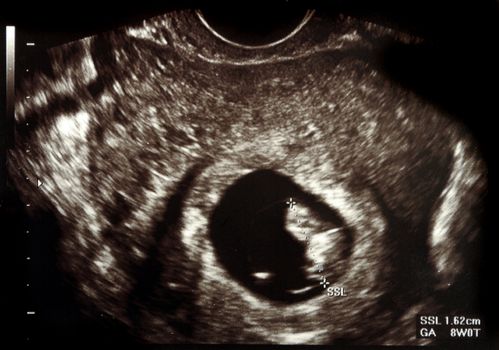 Ultrasound scans during pregnancy in the ninth week