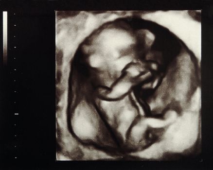 Ultrasound scans during pregnancy in the thirteenth week