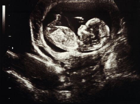 Ultrasound scans during pregnancy in the thirteenth week