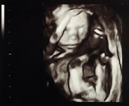 Ultrasound scans during pregnancy in the eighteenth week