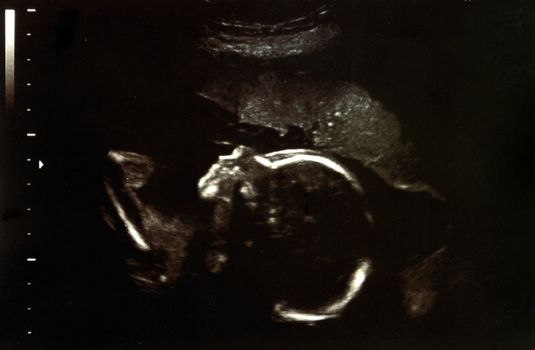 Ultrasound scans during pregnancy in the twentythird week