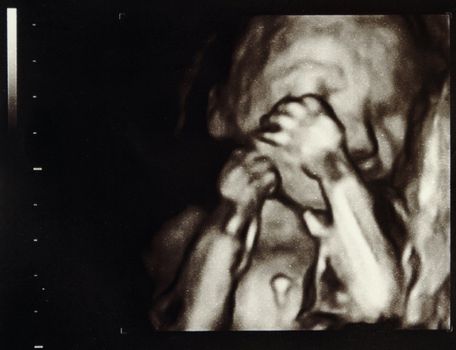 Ultrasound scans during pregnancy in the twentythird week