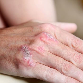 Severe psoriasis- psoriasis on the handbones - close-up