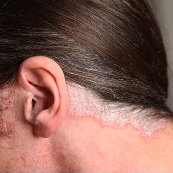 nahaufnahme-Severe psoriasis - psoriasis in the ear and neck - close-up
