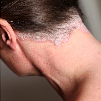 Severe psoriasis - neck , close-up
