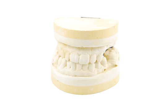 study model of a patient with several edentulous spaces