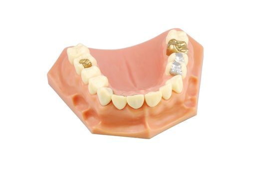 dental model showing different types of treatments (gold crown, porcelain veener, gold inlays, amalgam and composite fillings)