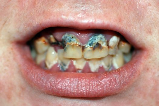A mouth with extremely bad tooth decay and dental caries.